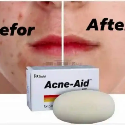 Acne aid soap